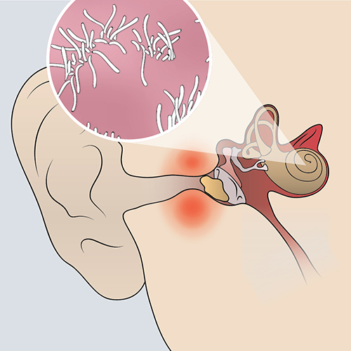 An illustration depicting mixed hearing loss